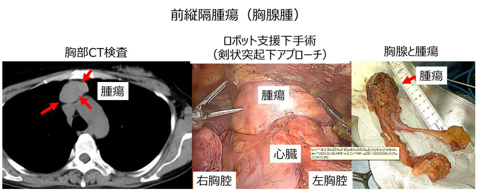 前縦隔腫瘍(胸腺腫)