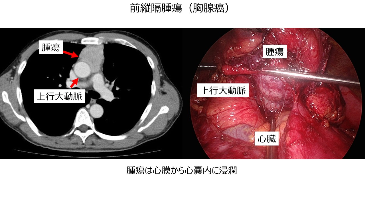 前縦隔腫瘍(胸腺腫)