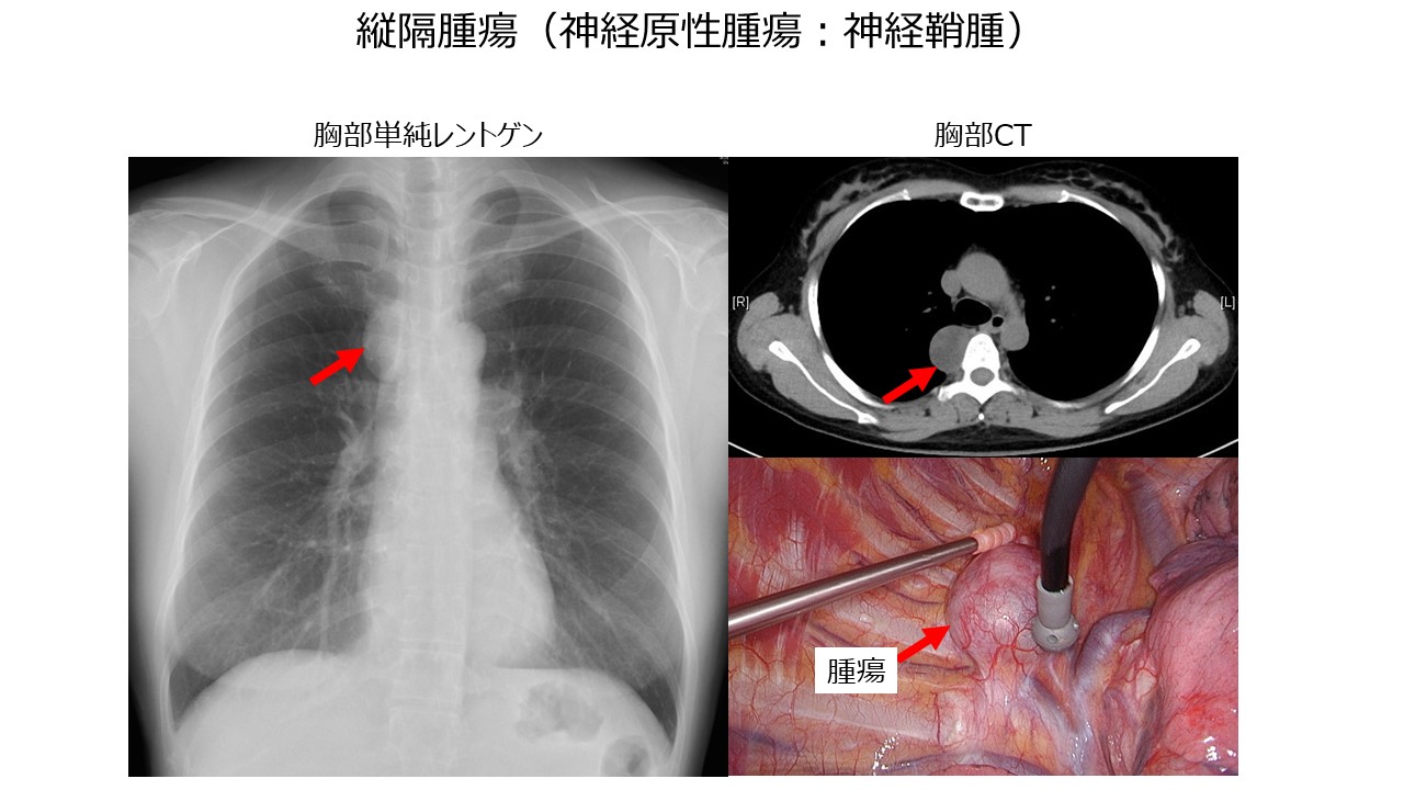 縦隔腫瘍(神経性腫瘍:神経鞘腫)