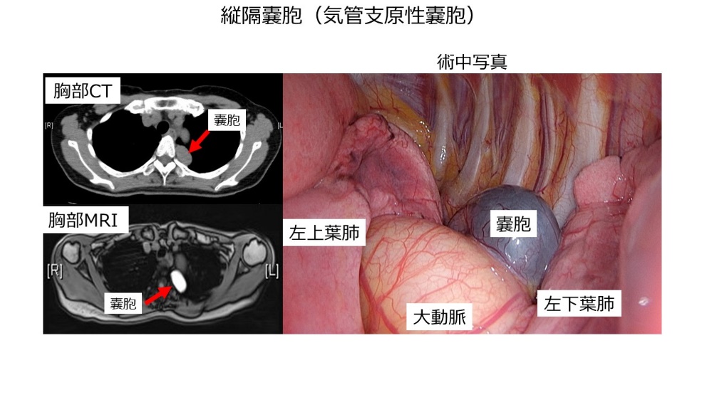 縦隔嚢胞(気管支原生嚢胞)