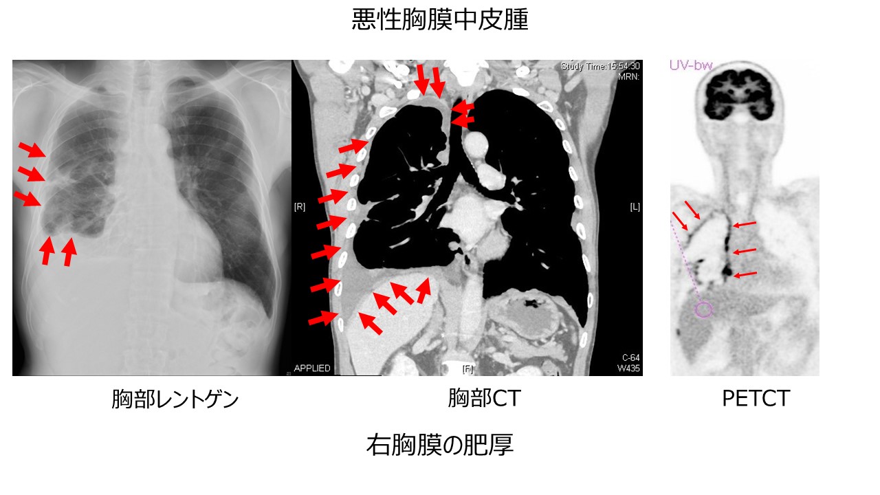 悪性胸膜中皮種
