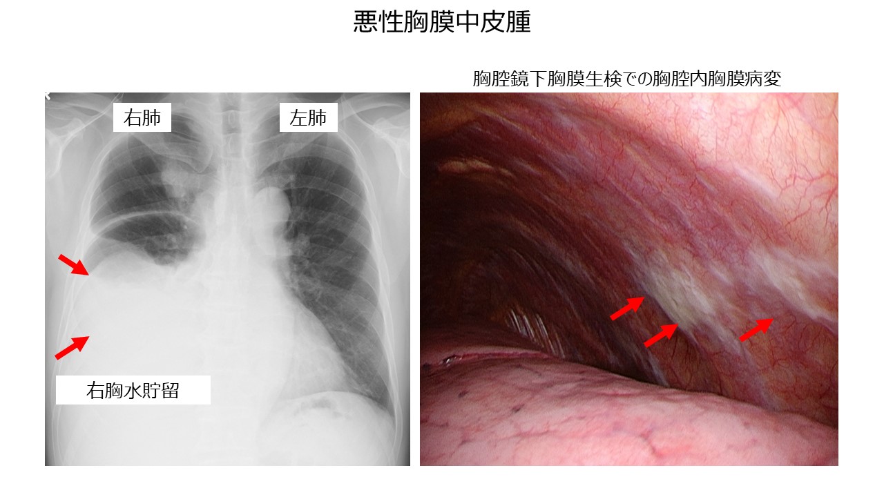悪性胸膜中皮種